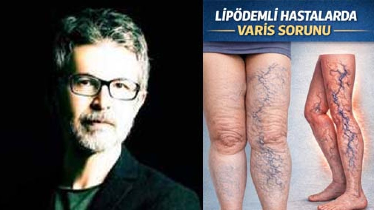 Lipödemli hastalarda varis sorunu: tedavide öncelik ne olmalı?